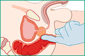 Massaggio prostatico - trattamento della prostatite