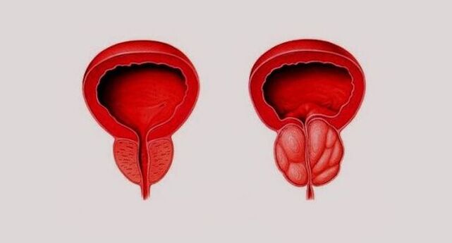 Prostata sana (a sinistra) e infiammata da prostatite (a destra)