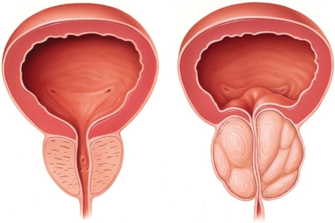 Prostata normale (a sinistra) e con segni di infiammazione nella prostatite (a destra)