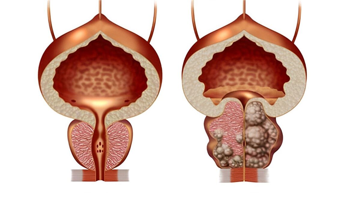 Che aspetto ha un adenoma prostatico 