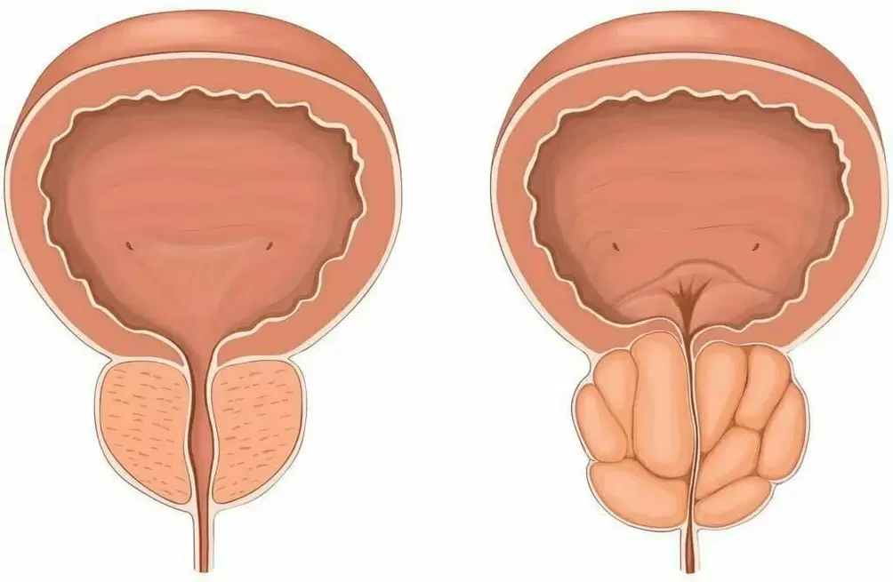 Prostata normale e prostata dolorante
